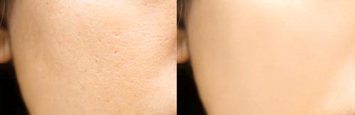 Comparison of a face with visible pores and no pores