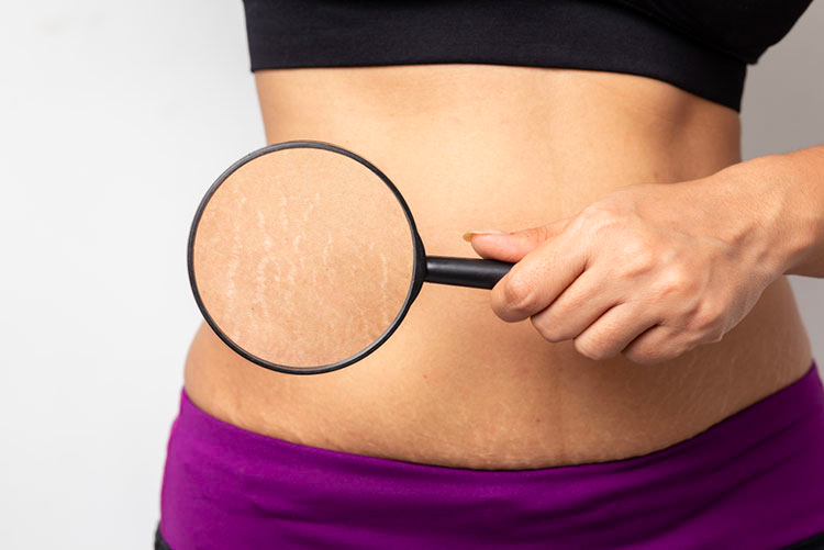 Woman holding a magnifying glass on her stretch marks!