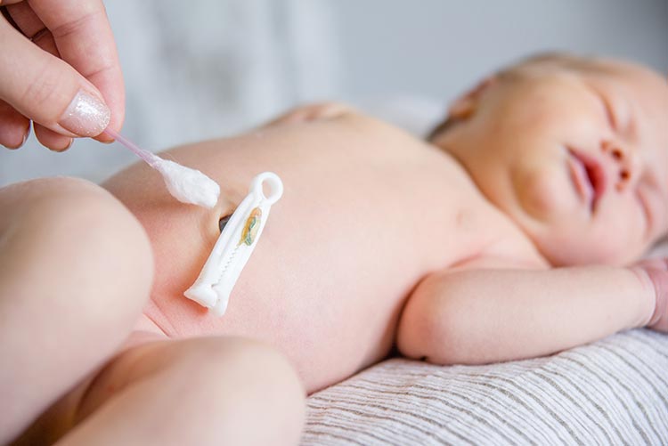 Rubbing alcohol being applied on the child's umbilical cord.