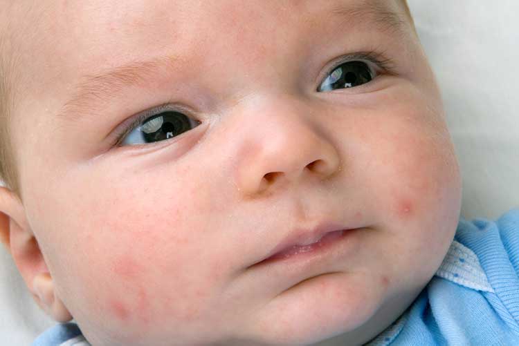 Closeup image of an infant with acne on his face.