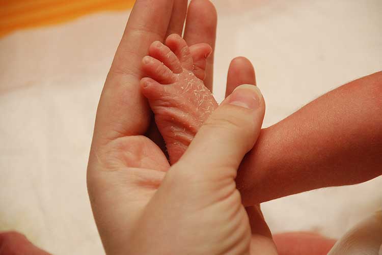 A newborn with flaky feet skin.