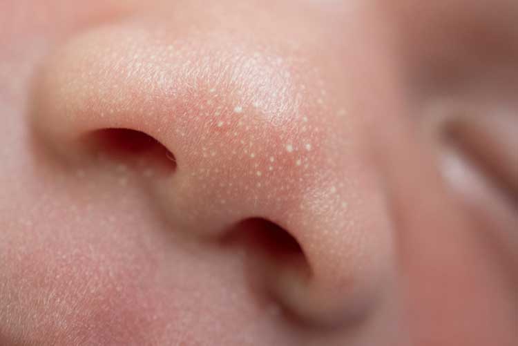 Closeup snap of milia on a baby’s nose.