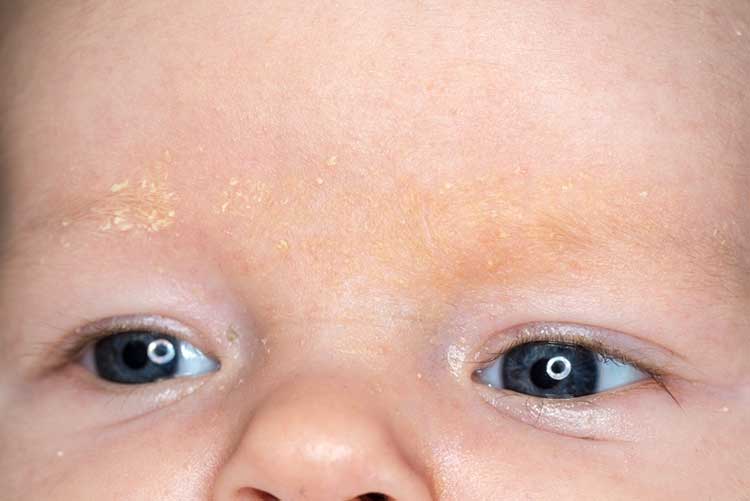 Cradle cap on a newborn’s eyebrows.