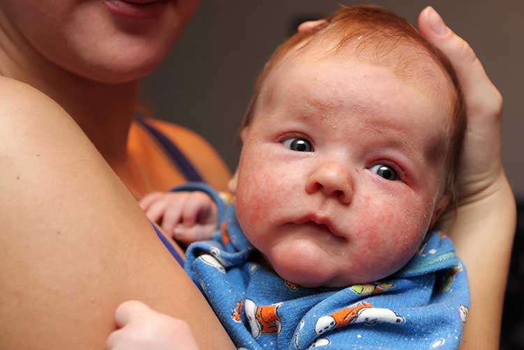 Baby’s face is covered with eczema.