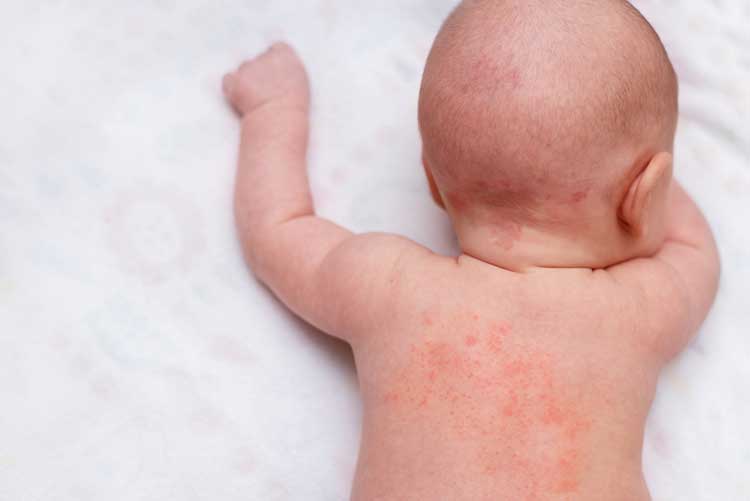 Prickly heat or heat rashes on a newborn’s back!