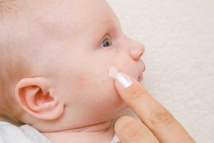 Mother applying an ointment on her baby’s rash on the face.