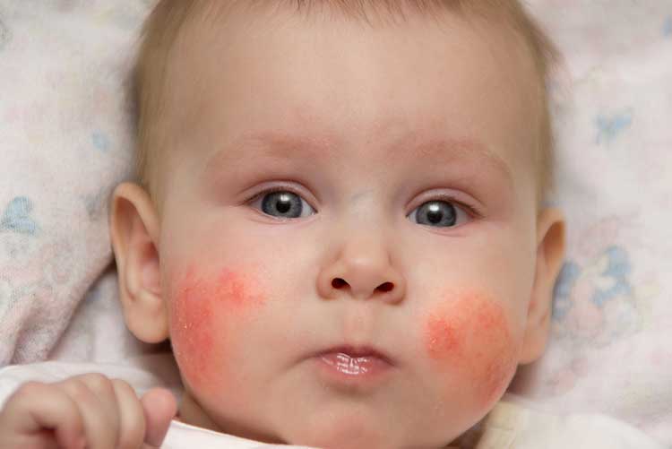 Baby girl with allergic rashes on her cheeks.