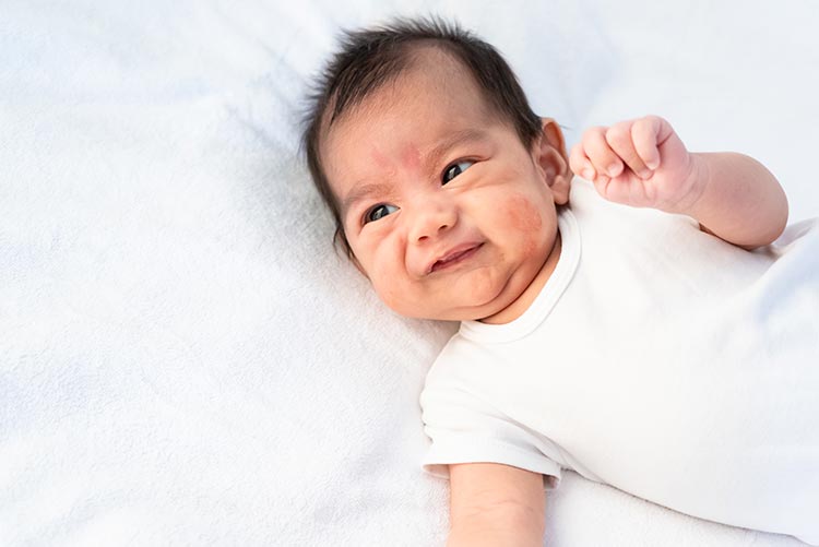 A young baby with rashes on its face.